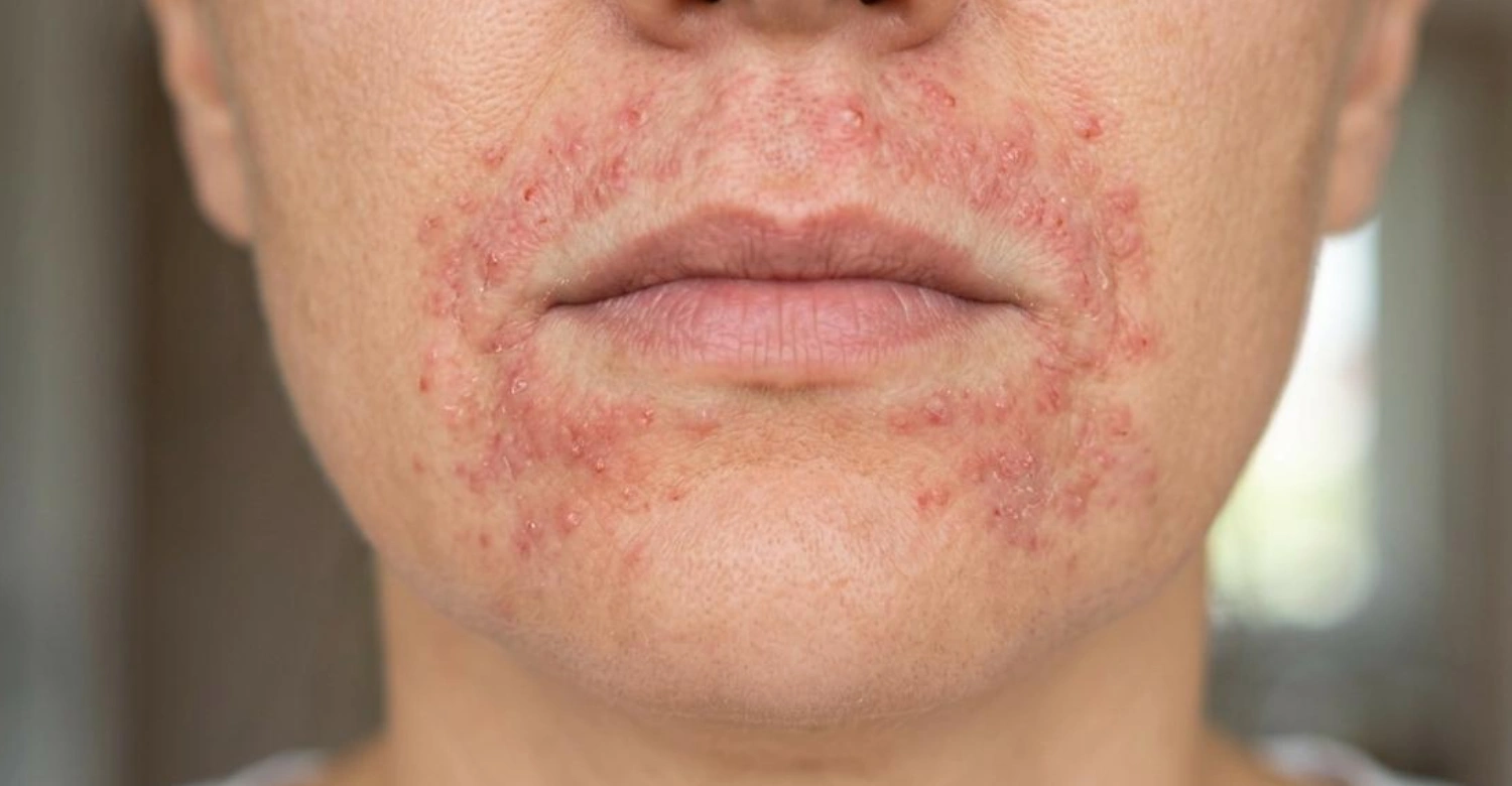 Perioral Dermatitis